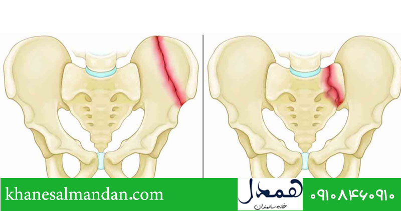 عوامل خطر در شکستگی لگن در سالمندان 