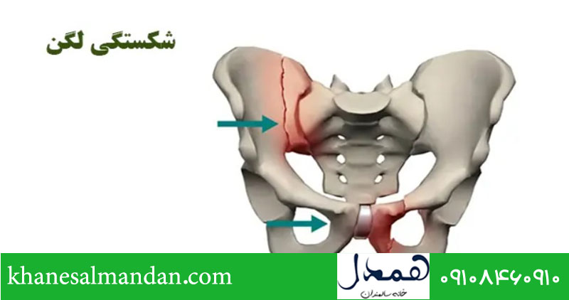 شکستگی لگن در سالمندان 