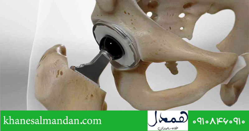 دوره بهبودی بعد از شکستگی لگن در سالمندان 